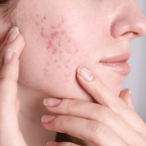Pourquoi calmer l’inflammation cutanée est essentiel lorsque l’on a la peau réactive ?